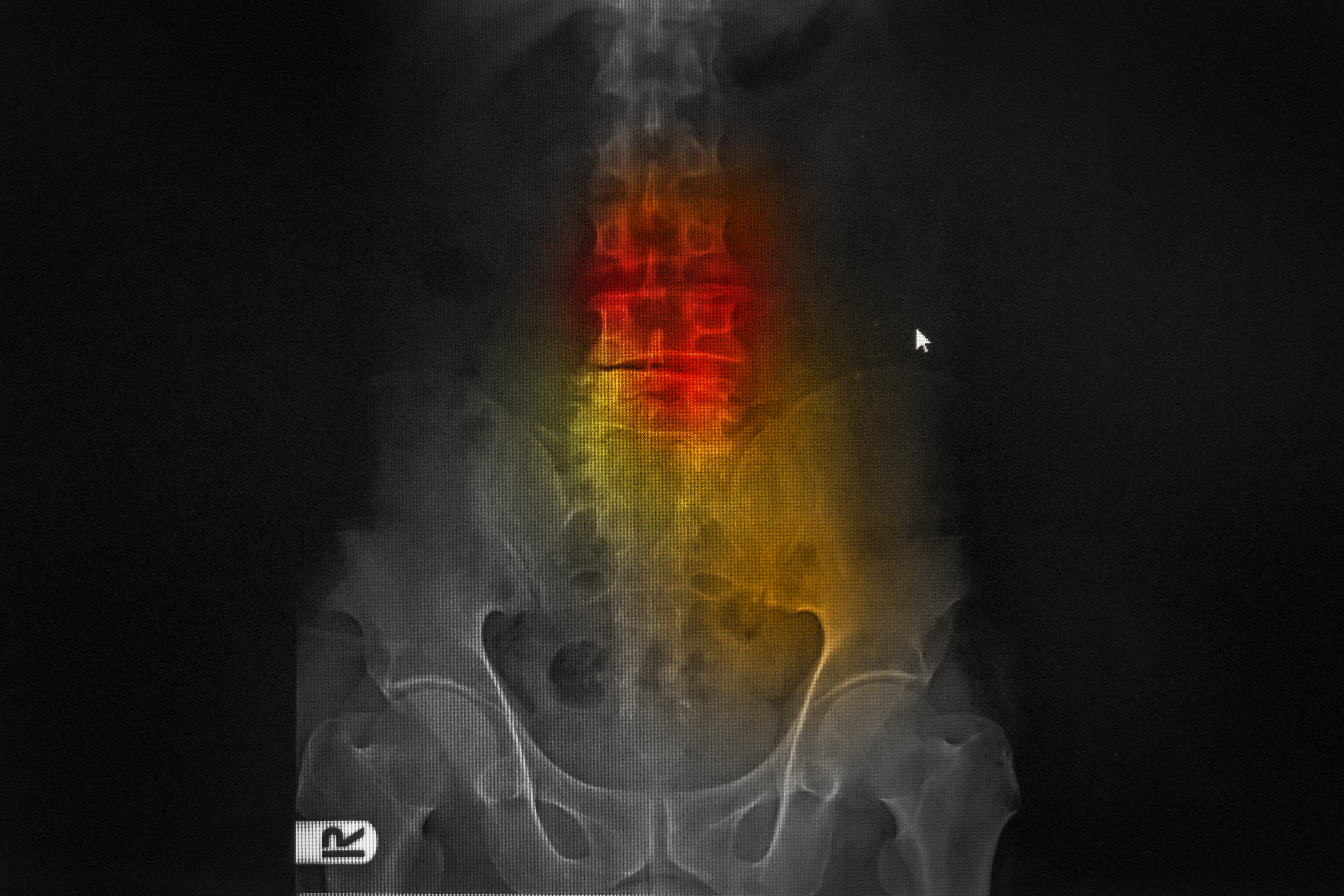 Compression Fractured Back shown in X-Ray