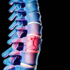 back fractures shown on vertebral body
