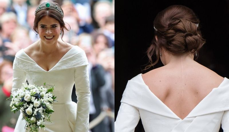 princess-eugenie-scar-1545593378